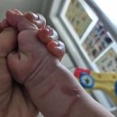 현대외과의원 | 인천 아기화상전문 정담외과/9개월아기 심재성2도화상/치료과정,비용/현대해상 보험금지급
