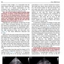 고양이에서 심초음파상 normal variant이지만 focal HCM으로 오인할 수 있는 LV 내 false tendons 이미지