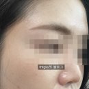 화성약국 | [내돈내산] 편평사마귀 레이저제거 (화성시, 강남) 병원 후기
