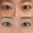 서클 | 강남피부과 미희주사 눈밑꺼짐과 다크서클 고민 해결 후기