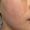 포마티 | 인모드 포마 효과 실제 경험으로 정리한 리얼 후기