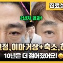 아내가 좋아하는 중년남성의 수술은?! 2년차 하안검+이마거상+이마축소+눈매교정 실제 경험담 이미지