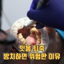 잇몸 퇴축 원인과 예방법: 방치하면 위험한 이유 이미지