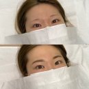 초잉브로우 | 제목은 [눈썹 문신 제거 후기]로 하겠습니다. 근데 이제 다시 눈썹 문신을 한.