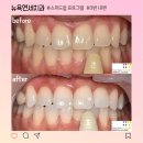 결혼 전 치아미백으로 빛나는 미소를
