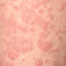 코로나가 피부 두드러기·자반증 유발.. 국내 조사 진행 중 이미지