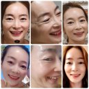 여드름 실종 사건😳
