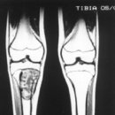 정강이뼈에 생긴 골육종 사진 이미지