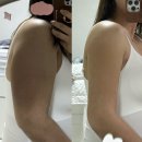 멍이날개 | 송도지방흡입 팔+견갑 지흡 2주차 실밥 뽑고 오다! - 밴드/멍/붓기 관리 추천템 꿀팁