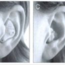 광교 덴마크보청기 이미지