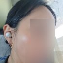 세종뷰티의원 | 세종에서 편평사마귀 뺀 대만족 후기