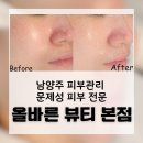 올바른영양 | 남양주피부관리 올바른뷰티 후기, 문제성피부에도 효과 있었어요