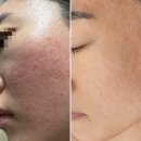 한불스킨케어 | 지루피부염, 주사피부염에 날치알 농포, 모낭염까지 올라오면 진짜 난감하죠