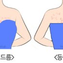 가슴 뾰루지, 가슴 여드름 원인 및 가드름 예방법 이미지