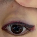 제이유의원 | 도곡피부과 아이라인문신 제거 1차후기 “제이유피부과의원”