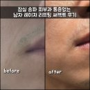 잠실새내역 2번출구 | 잠실새내역 피부과 통증 없는 남자 팔자 주름 리프팅 써펙트 후기