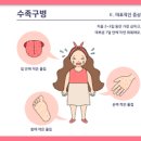 수족구 ,원인,예방하기 (수족구병) 이미지