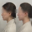 왕십리 윤곽관리 디유에스테틱 이중턱 관리 후기