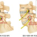 ‘풍선확장술’ 이용한 척추 협착 새 치료법 개발 이미지