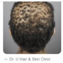 서울넘버원신경외과의원 | 위고비부작용, 탈모가 걱정돼요 [서부통신경외과] 대구 대명동, 송현동, 달서구, 남구, 본리동, 성당동