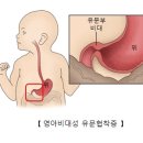 비후성 유문협착증[hypertrophic pyloric stenosis] 이미지