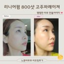 월곡댁 | [공지] 노원리프팅 리니어펌 800샷 받은 N일차 후기 기록