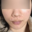 (주)이사플러스 | 하이포커스샷 플러스 효과 전후 땅콩형 후기 메디큐브 내돈내산