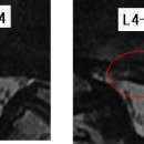 벤자민 님의 척추관협착증, 요추디스크 L4-5, L5-S1의 MRI 사진 판독입니다. 이미지