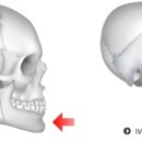 주걱턱 의 수술 교정 - 주걱턱 수술을 이용한 주걱턱 교정 이미지