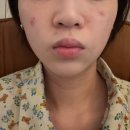 한미사우나 | 홍대피부과추천 리쥬란 잘하는곳 솔직후기