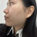 아하한의원 | 강남여드름한의원 새살침 여드름패인흉터 후기 | 내돈내산 전후 효과·통증·비용까지