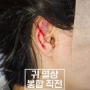 아문성형외과의원 | 귀 절단 상처 봉합 후기 (서울 강동구 아문성형외과)