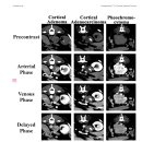 Triple-phase helical CT를 사용한 부신 종양의 감별 이미지