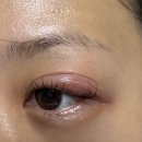 정부과천청사부속의원 | 다래끼 한달 반 관리 과정, 안산 에스안과 콩다래끼 절개 후기