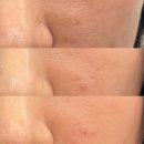 서울피부과 포텐자 시술 엑소좀 후기 콜라겐스킨부스터 추천