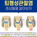 류마티스 관절염 퇴행성 관절염 원인 초기 증상 류마티스관절염 퇴행성관절염 차이점 치료방법 이미지