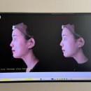 아현역 | w16. 아현역피부과 코실리프팅 테스코 내돈내산 후기(가격, 효과) 예비신부관리