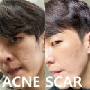 서브PC | 서브시전 여드름 패인흉터 시술 2년 치료 여정, 피부과 내돈내산 찐 후기!