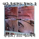 B10-2 | 두피비듬관리,대구두피케어 잘하는 곳 | 동성로 / B10 (비텐) 에스테틱