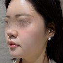 리뉴얼의원에서 여름맞이 청담 리투오 관리받은 후기