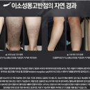 몽고반점 이미지