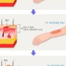 1도 2도 3도 화상 증상 통증 기름 식도화상 저온화상 원인 치료 이미지