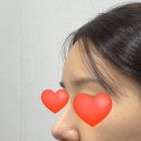 (주)아이벡스메디칼시스템즈 | 코수술 후 염증 반응, 고압산소치료 받아본 내돈내산 후기