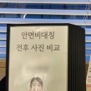 청담한의원 | 청담 안면비대칭 교정/턱관절 한의원 교정치료 후기 - 얼굴비대칭 증상, 비용