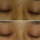 다크서클 이미지