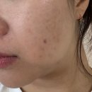 분당-205 | 분당 여드름 유온리 에스테틱 베이직 관리 후기