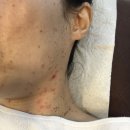 (주)하영메디칼 | 끝나지 않은 편평사마귀와의 전쟁.. 세번째 레이저 치료 후기