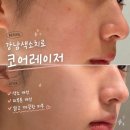코어프로세스 | [강남색소치료] 코어레이저 상담부터 시술 후 경과까지 내돈내산 솔직 후기