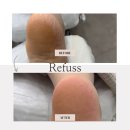 내성지구대 | 천안무좀내성발톱 불당동 레푸스에서 발각질 관리 받은 후기