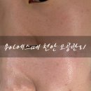 동남바이오 | 천안에스테틱 우아에스떼 나비존 마이크로젯 BIOFOX 후기